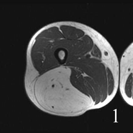 Tumor Surgery : Bone Cancer Tumors : Sarcoma Surgeon : NYC