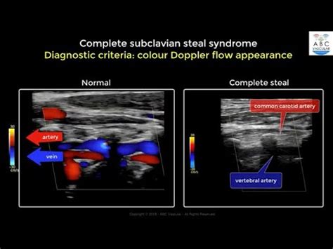 Complete Subclavian Artery Steal Syndrome ultrasound criteria - YouTube