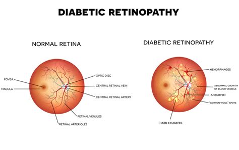 Diabetic Eye Exam FAQs | Optometrist in Modesto, CA