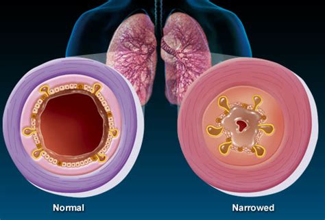 Asthma - Child Health