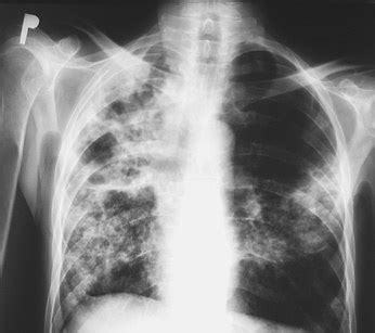 Tuberculosis chest x ray - wikidoc