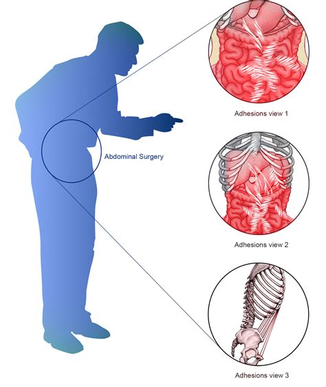 Can scar tissue cause abdominal pain? – Abdominal pain