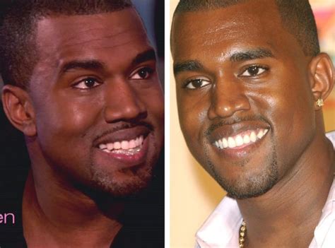 Kanye West Teeth Before And After Photos; Kanye West Replaces His ...