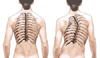 Adult Degenerative Scoliosis