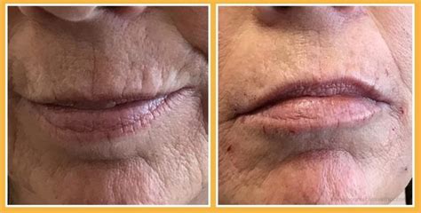 Upper Lip Wrinkles: Causes and Treatments - Bonnie Bliss