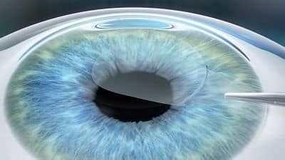 LASIK | LASIK Eye Surgery Cleveland | Cleveland Eye Clinic