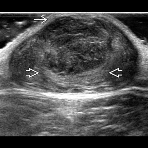 Subcutaneous Dermoid Cyst Ultrasound