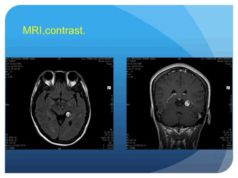 Surgical Neurology International