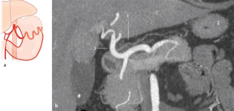 Gastric Arteries | Radiology Key