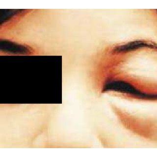 Romana’s sign is characterized by unilateral palpebral edema ...