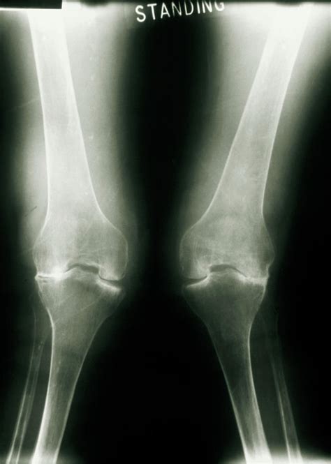 X-ray Of Knee Joints With Rheumatoid Arthritis by Medical Photo Nhs ...