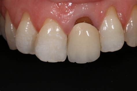 Post & Crown Procedure – Dentistry.com