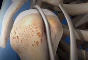 Biceps Tenodesis Surgery | Description and Treatment