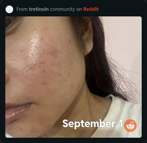 Before and after : r/tretinoin