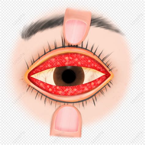 Hand Drawn Science Trachoma Symptoms, Eye Cataract, Medicine, Sick PNG Transparent Background ...