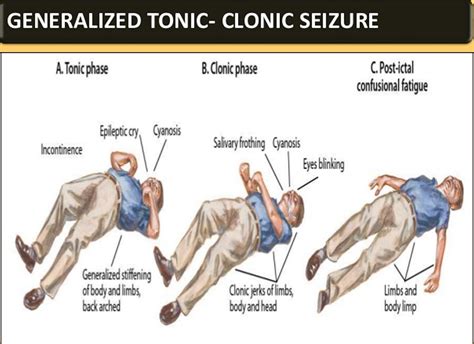 Grand Mal Seizure - Causes, Symptoms, After Effects, Recovery Time