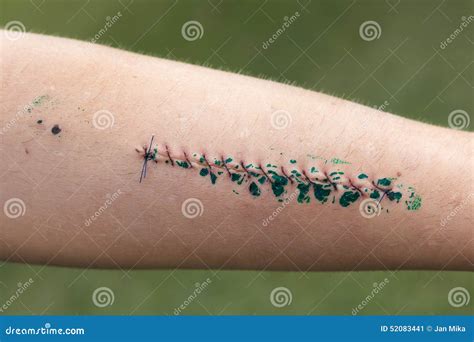 Wound And Stitches On Forearm Stock Photo - Image: 52083441