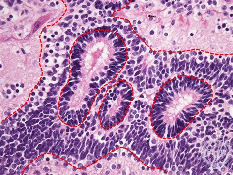 Teratoma Histology