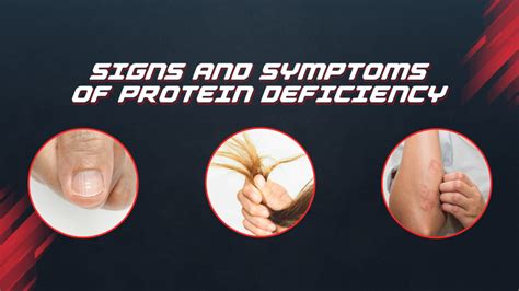 What Is Protein Deficiency? Causes, Signs, And Symptoms