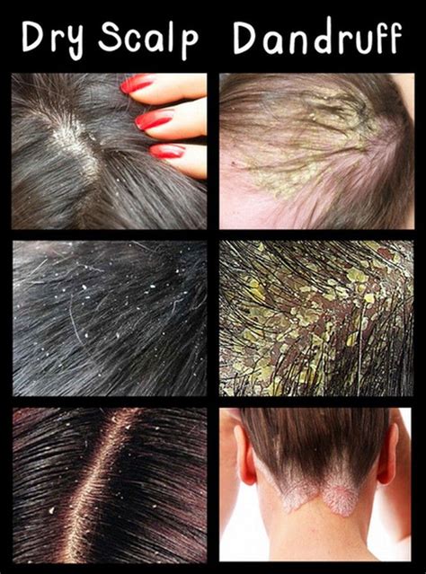 It can be caused by severe dehydration and over-shedding of the scalp, using poor quality ...