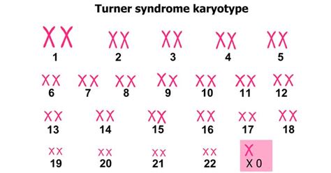 Who Can Get Turner Syndrome & How to Deal With it?