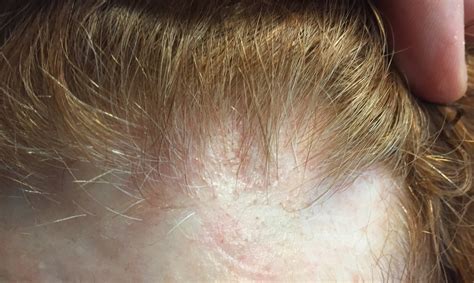 Do I have Frontal Fibrosing Alopecia? — Donovan Hair Clinic