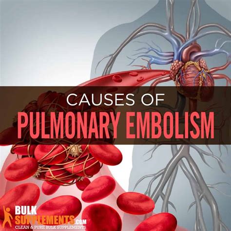 Pulmonary Embolism. Stop Blood Clots With Our Supplements.