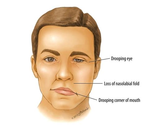 Bell’s palsy - Symptoms, causes and other risk factors