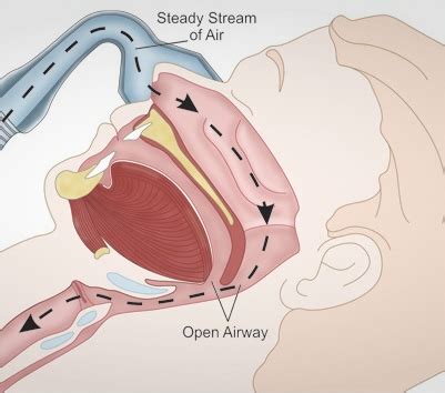 CPAP Therapy | ISD Health Solutions