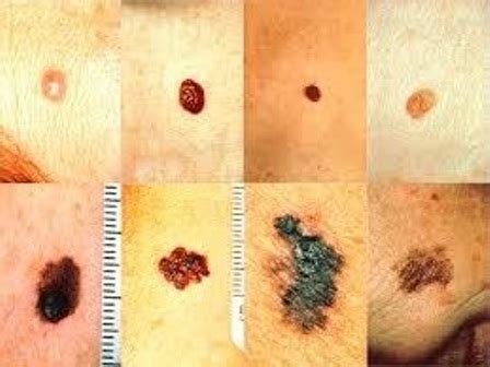 Skin cancer can happen to anybody. Although people with light skin are easily..