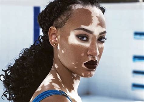 Amy Deanna has vitiligo, and she's CoverGirl's new makeup star, Women News - AsiaOne