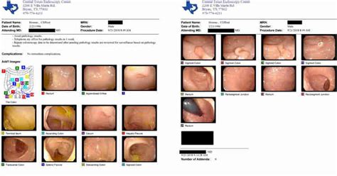 Colonoscopy Results After NOT Following My Protocol for One Year | IBD ...