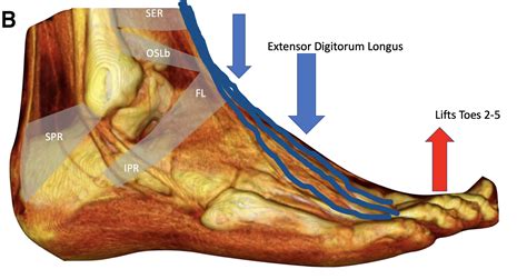 Extensor Digitorum Longus Tendon Pain