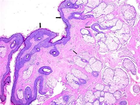 Dermoid cyst: symptoms, treatment and consequences | Diseases and conditions 2024