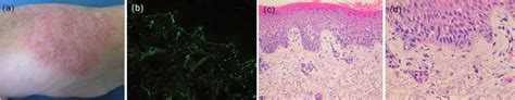 Patient 1 with eczema. (a) Erythematous lesion with crust on the back... | Download Scientific ...