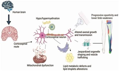 Paraplegia meaning, causes, symptoms, diagnosis, treatment & prognosis