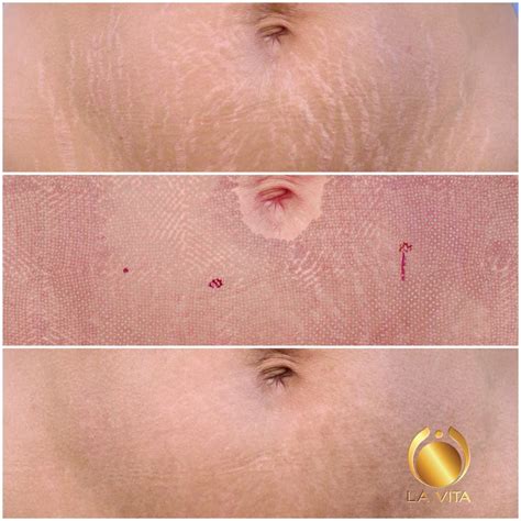 Co2 Laser Resurfacing - La Vita Medical Spa & Dental Clinic