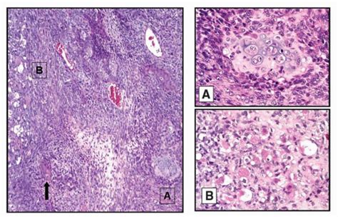 Sarcomatoid (Sarcomatous) Carcinoma | Oncohema Key