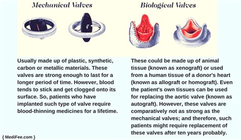 Surgery for Replacement of Aortic Valve: Risks and FAQs