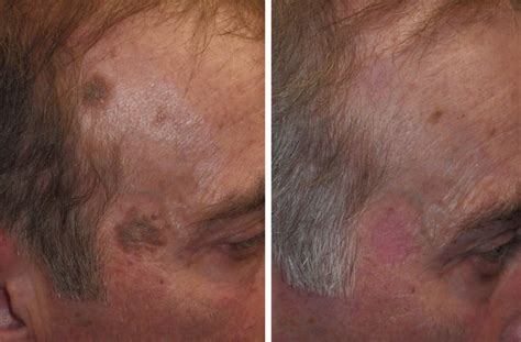 Seborrheic Keratosis: old age spots