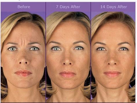 Before and after Botox injection #AntiAgingTips #AcneScarsRemedies # ...