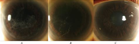 Fibrin glue for prevention of recurrent epithelial ingrowth under a LASIK flap with a central ...