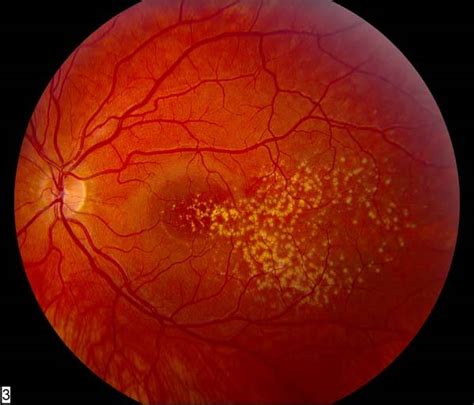 Age-Related Macular Degeneration (ARMD) - Ophthalmology - Medbullets ...