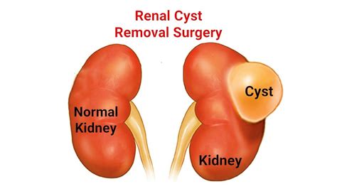 Renal Cyst Excision treatment cost in Delhi| Laparoscopic Renal Cyst Excision treatment cost in ...