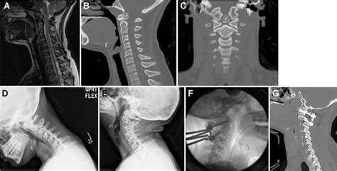 Incidental os odontoideum: current management strategies in: Neurosurgical Focus Volume 31 Issue ...