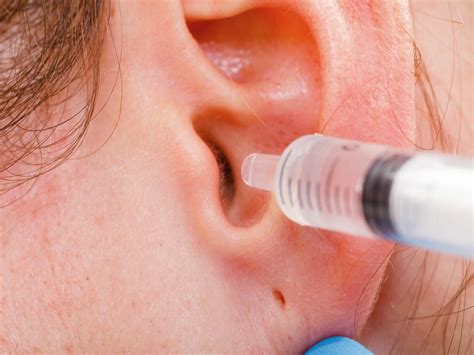 Cerumen (Ear Wax) Impaction Removal at MD First Primary & Urgent Care