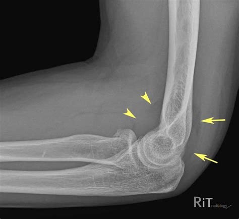 RiT radiology: The Fat Pad Sign