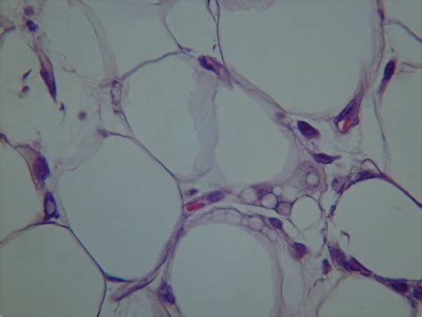 Liposarcoma: Well Differentiated Liposrcoma: Low Grade Liposarcoma: Atypical Lipoma: Soft Tissue ...