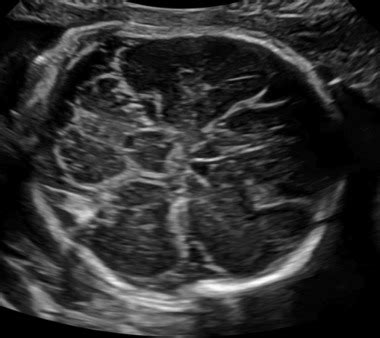 Holoprosencephaly Ultrasound