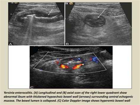 Presentation1.pptx, ultrasound examination of the appendix. | PPT